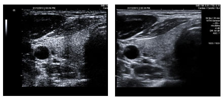 Example of a thyroid image, without and with spatial compounding speckle reduction