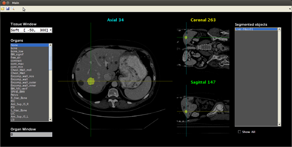 Triradiate Industries Liver Mass Viewer