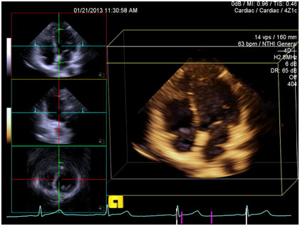 Volume cardiac image with multiplanar reformatting