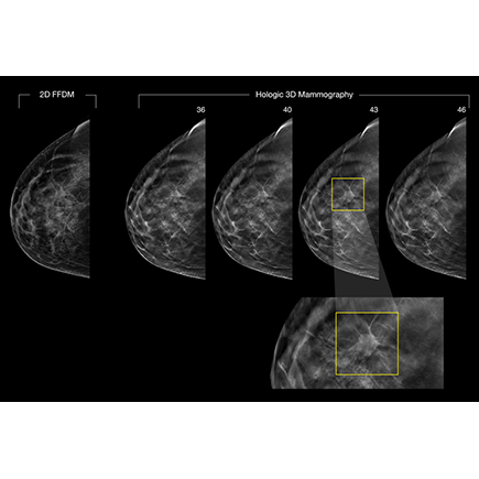 Bettering Breast Cancer Detection Rates