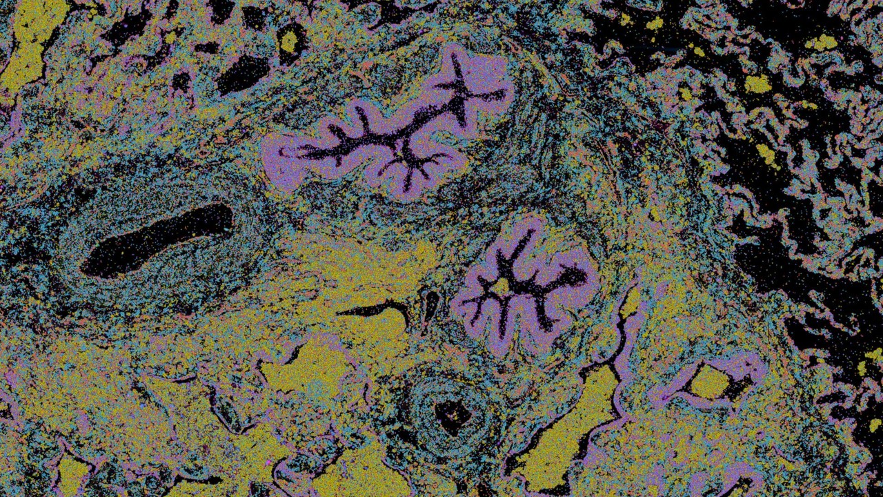 Menschliche Lungenproben laufen auf dem 10x Genomics Xanium Analyzer