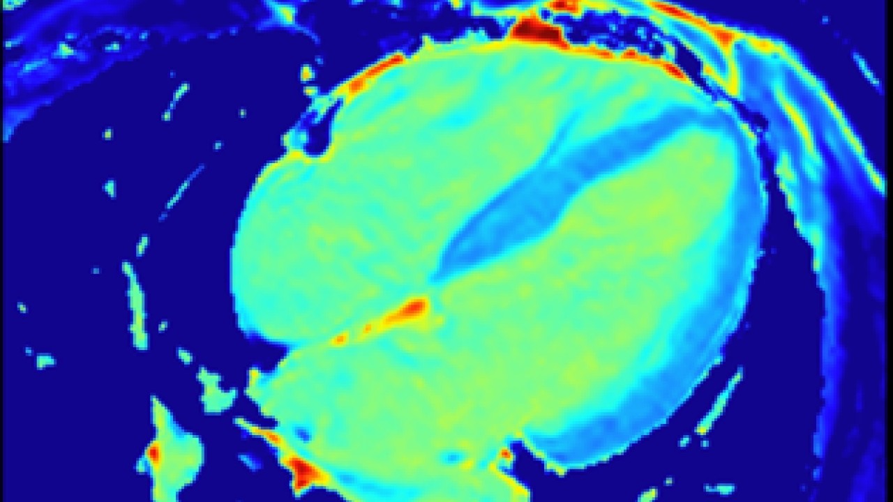 AI-Powered MR Imaging to More Patients