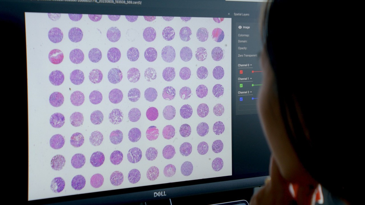 Doctor evaluating potential cancer cells.