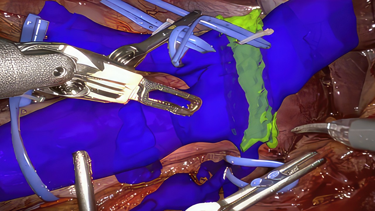 NVIDIA Holoscan: Real-time AI in surgery